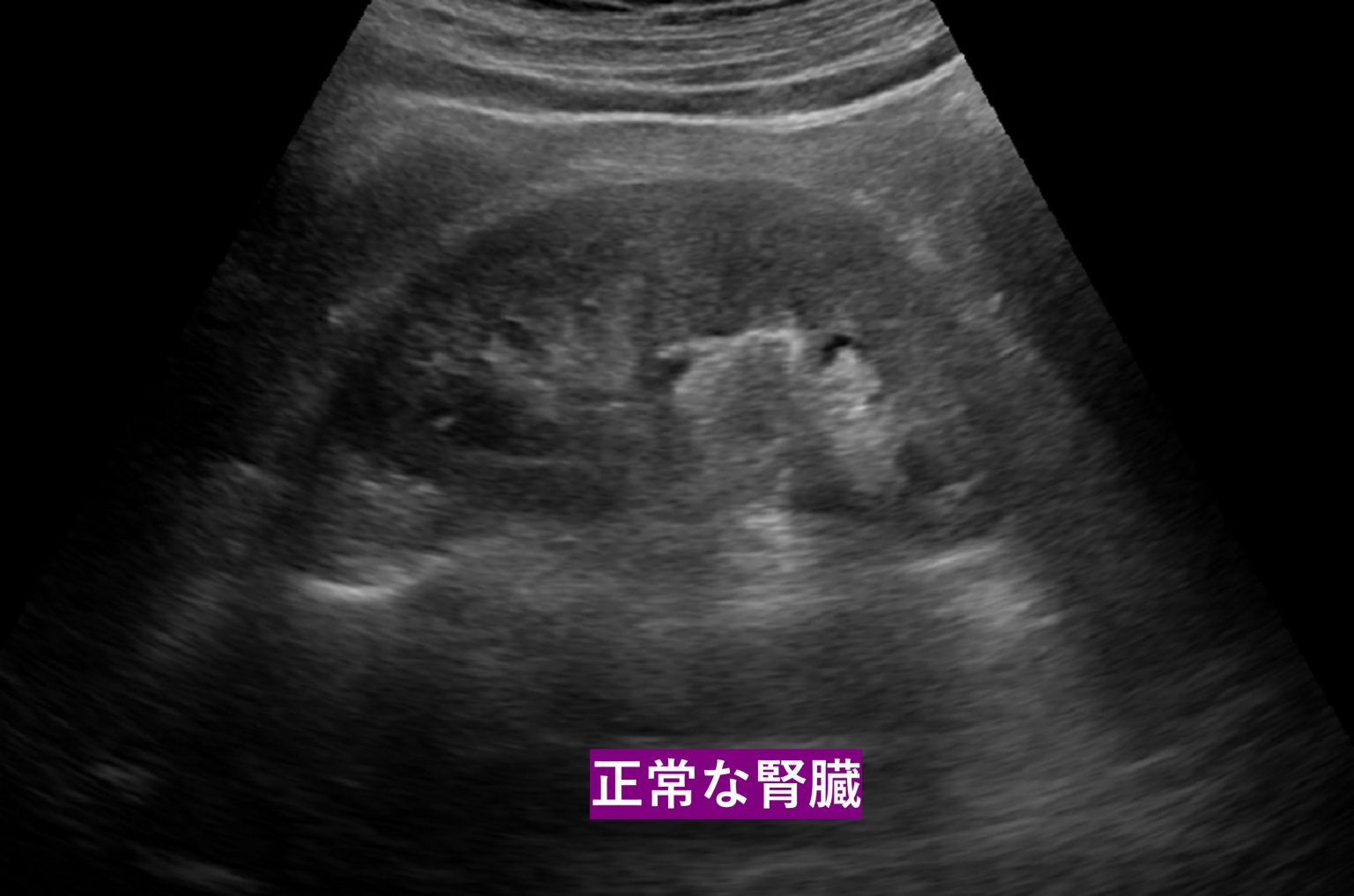 腎臓がん・腎嚢胞・腎血管筋脂肪腫の症状・原因・検査について東京都新橋駅1分のの泌尿器科クリニック