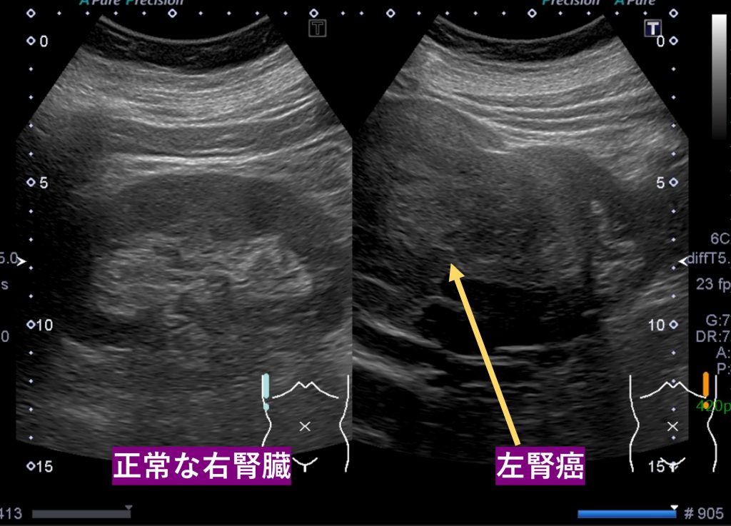 腎臓がん・腎嚢胞・腎血管筋脂肪腫の症状・原因・検査について東京都新橋駅1分のの泌尿器科クリニック
