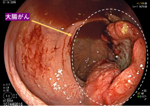大腸がんの初期症状・原因(リスク)・検査・治療について|東京都新橋駅徒歩1分の消化器科クリニック