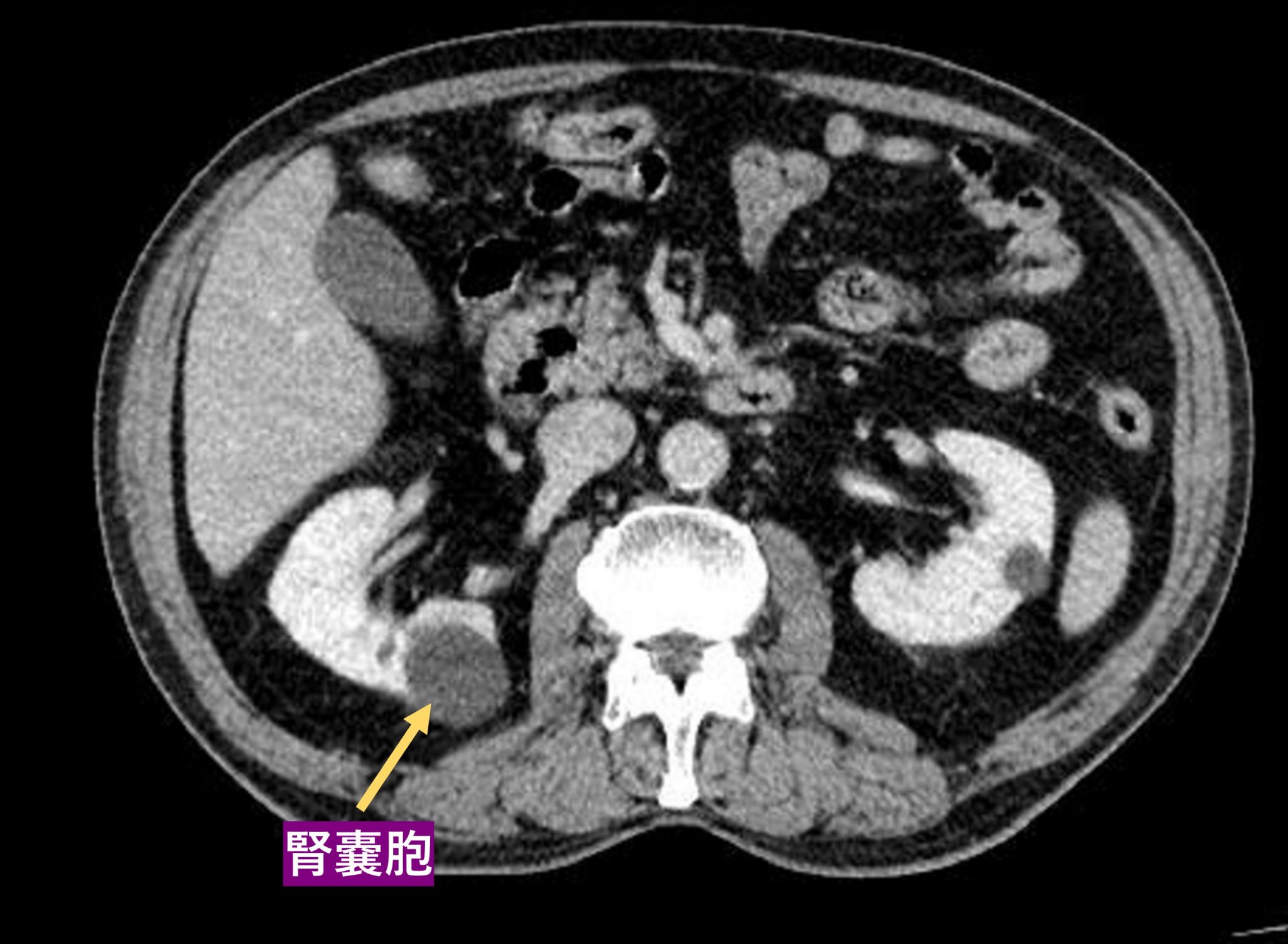 腎臓がん・腎嚢胞・腎血管筋脂肪腫の症状・原因・検査について東京都新橋駅1分のの泌尿器科クリニック