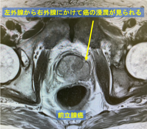 前立腺癌 4c6696950cdf2e8366cf95e5f552eb