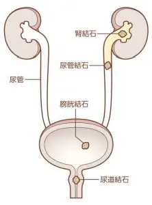 尿管結石・尿路結石の原因、症状、検査、治療について | 新橋消化器内科・泌尿器科クリニック