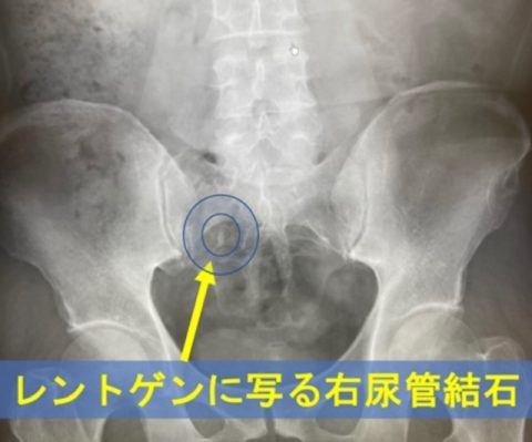 腎臓結石のX線検査は必要ですか?