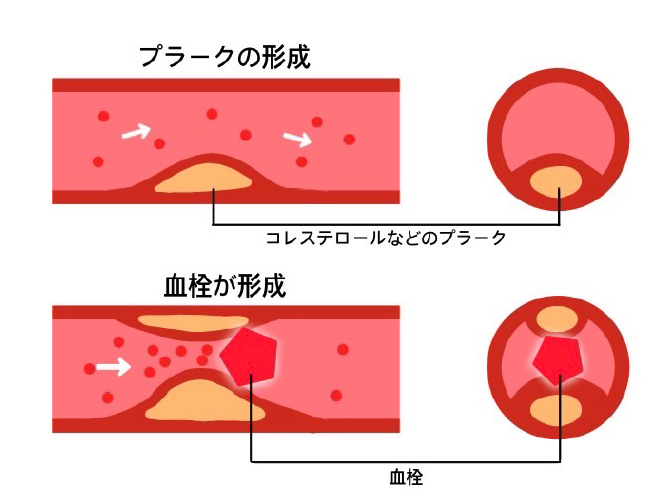 脂質異常症の症状・原因・⾷事・検査・治療について |新橋消化器内科・泌尿器科クリニック