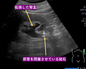 尿管結石・尿路結石の原因、症状、検査、治療について | 新橋消化器