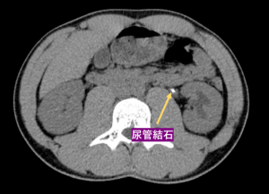 尿管結石・尿路結石の原因、症状、検査、治療について | 新橋消化器内科・泌尿器科クリニック