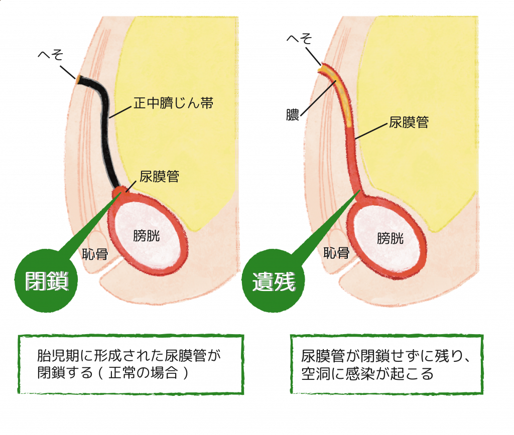 へそ 臭い