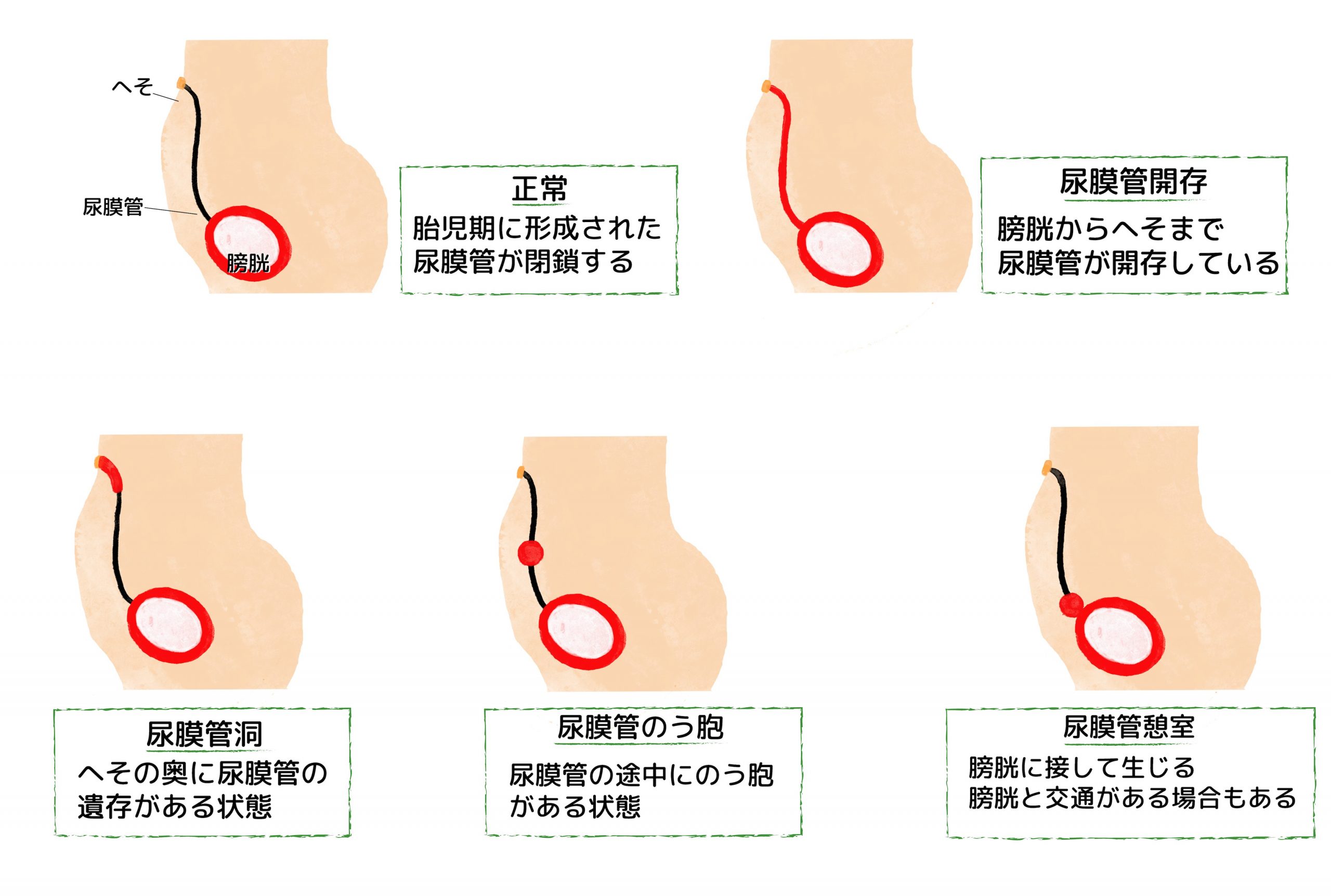 へそ 臭い